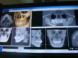 歯科用CT